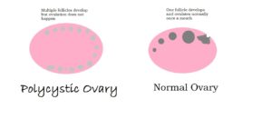 Female infertility causes | PCOS