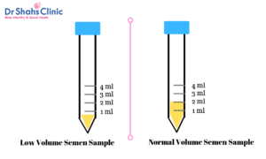 semen volume | sperm test | semen analysis | semen analysis test in chennai