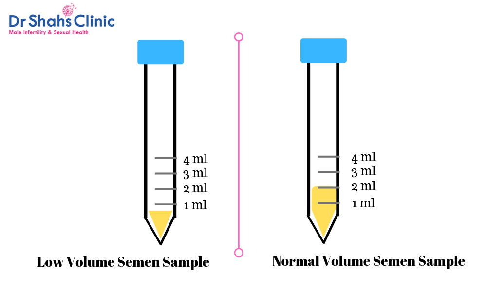 Semen Analysis Test In Chennai Sperm Test In Chennai At Dr Shahs Clinic 