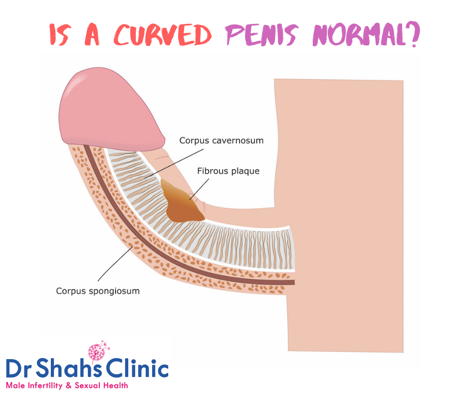 Is a curved penis normal