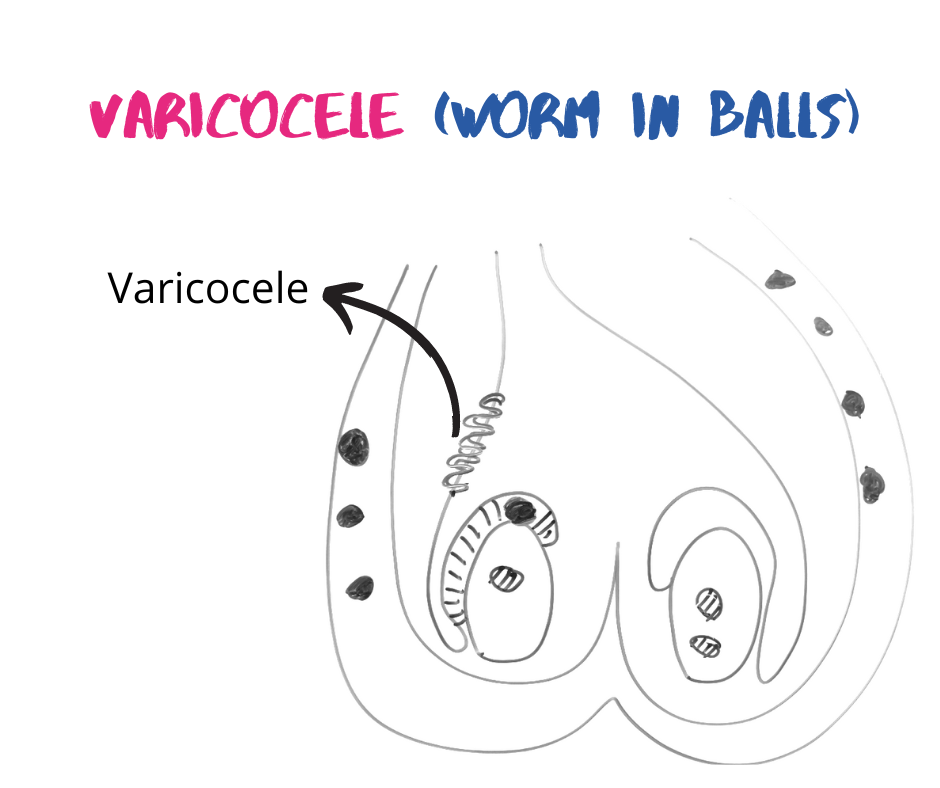 Varicocele lump in balls