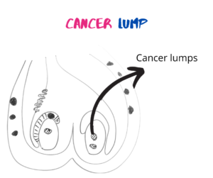cancer testicular lumps | lumps in ball