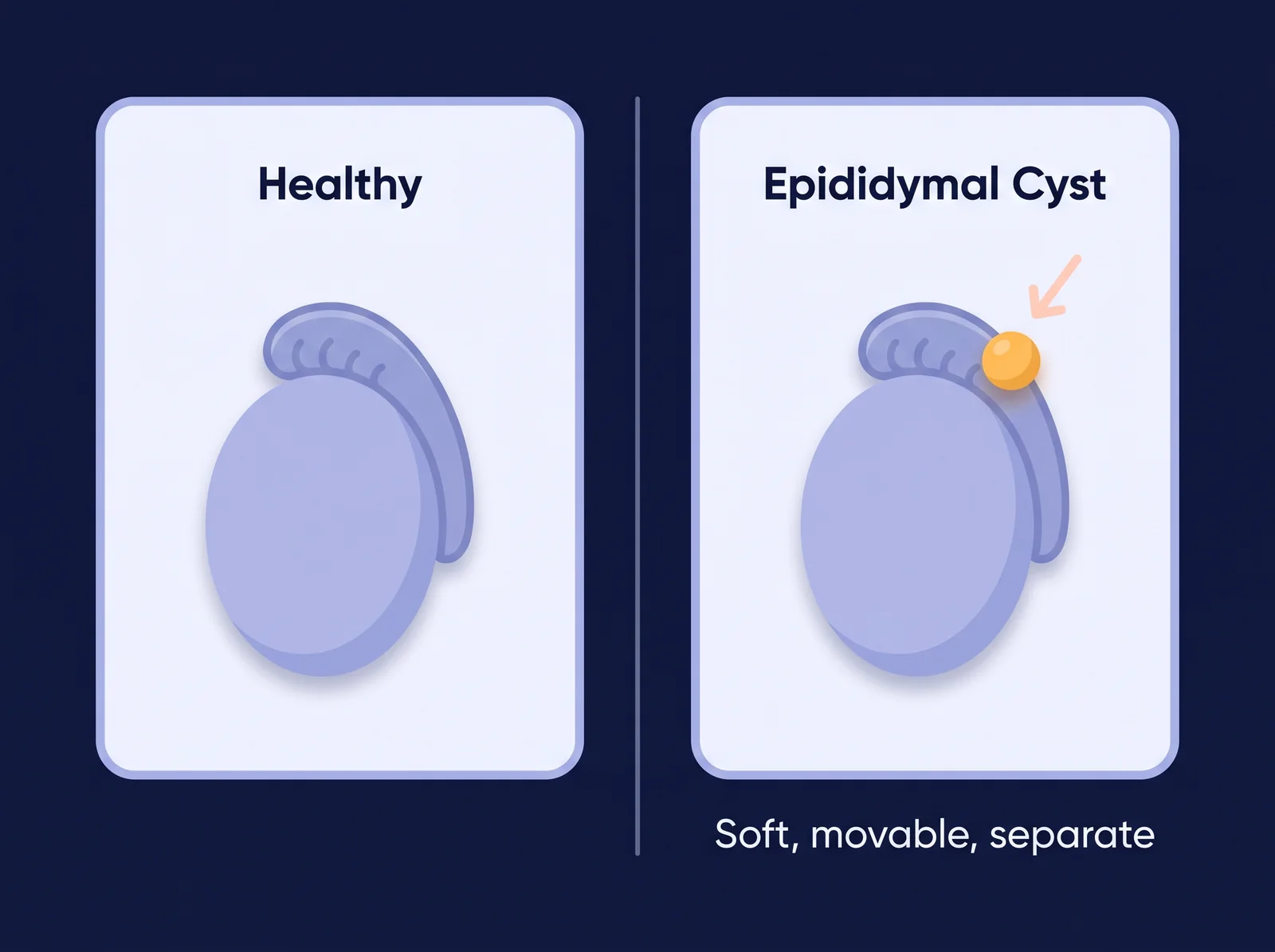 Epididymal cyst: a soft pea separate from the testicle Conceptual diagram of an epididymal cyst — a soft, movable, pea-sized lump that sits separate from the testicle and is harmless