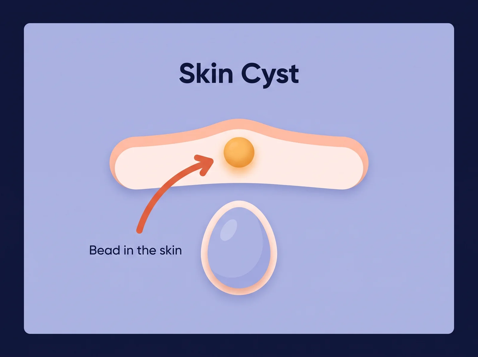 Sebaceous cyst: a firm bead in the scrotal skin Conceptual diagram of a sebaceous cyst — a firm, harmless lump in the scrotal skin, not a lump on the testicle itself
