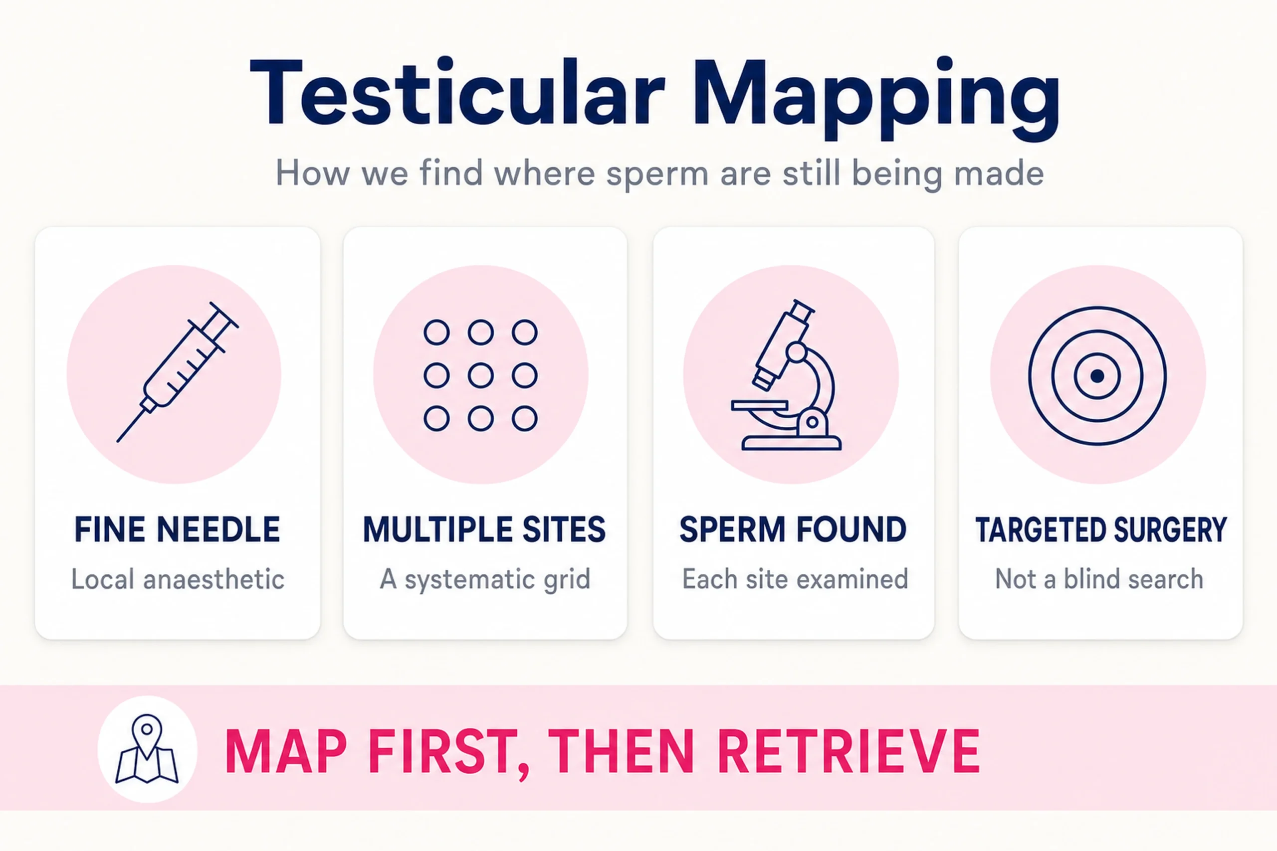 Testicular mapping for azoospermia: fine needle under local anaesthetic, multiple sites sampled on a systematic grid, each site examined for sperm, then targeted surgery