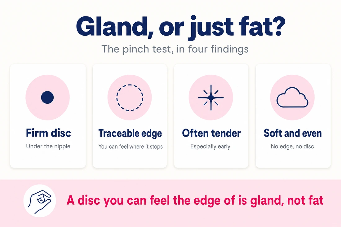 Gynecomastia pinch test infographic: firm disc under the nipple, traceable edge and tenderness, versus soft and even chest fat with no edge