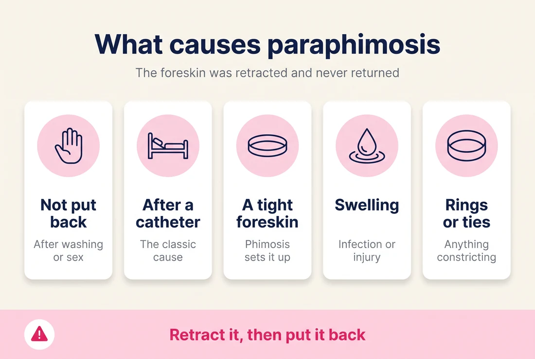 What causes paraphimosis: foreskin not put back after washing or sex, after a catheter, a tight foreskin, swelling from infection or injury, and constricting rings or ties